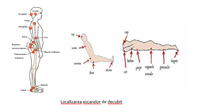 Localizarea escarelor de decubit 
